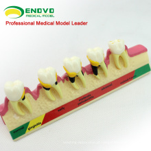 Super Setembro VENDA 12585 Classificação Modelo Periodontal 2x Dentes em Tamanho Real Doença